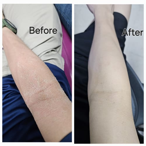 Customer photo review of Eczema Scratch Mitten