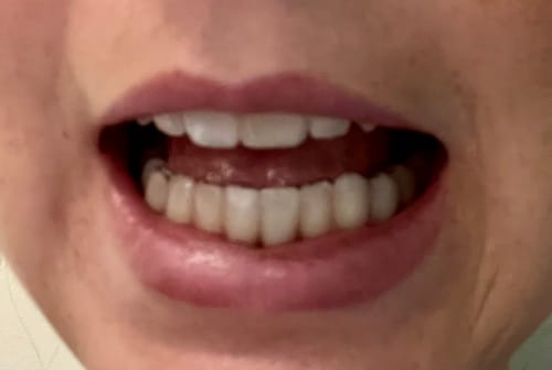 Customer photo review of Lower Partial Denture Retainer (1 Tooth Only)