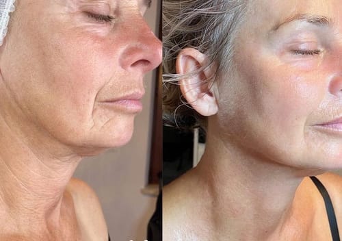 Customer photo review of Nuvee® Wrinkle Patches