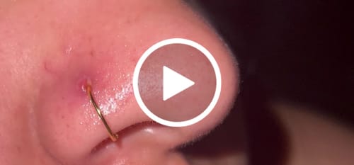 Customer video review of Hypochlorous Acid Spray for Skin & Face | Healing Topical Spray