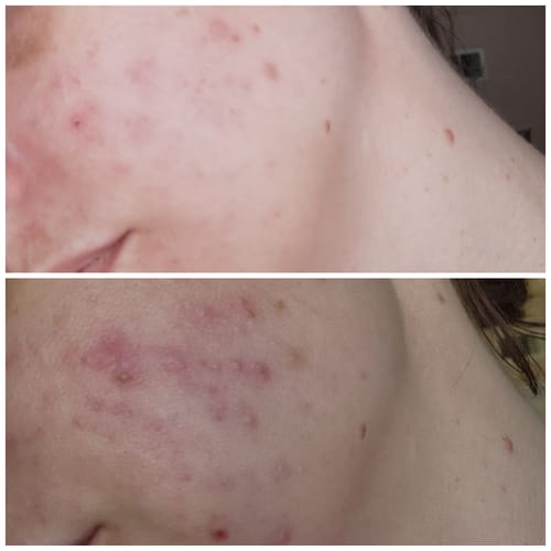 Customer photo review of Dermathod Priming Peel Booster