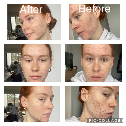 Customer photo review of Advanced Acne Program™