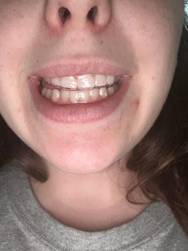 Customer photo review of Upper and Lower Retainers Set