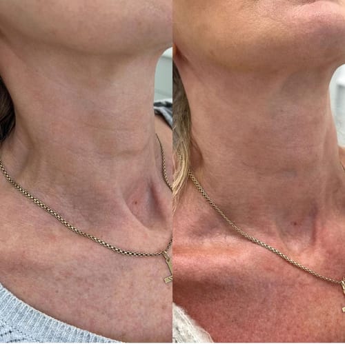 Customer photo review of Nuvee® Wrinkle Patches