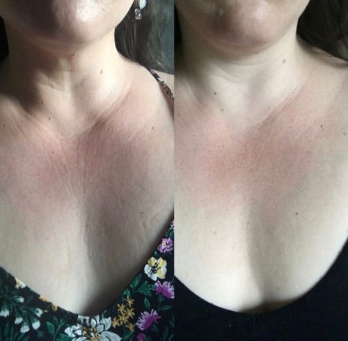 Customer photo review of Nuvee® Wrinkle Patches