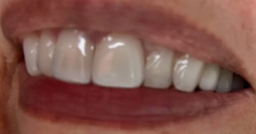 Customer photo review of Premium Upper Retainer