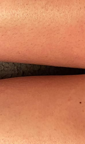 Customer photo review of Nuvee® IPL Hair Remover Pro