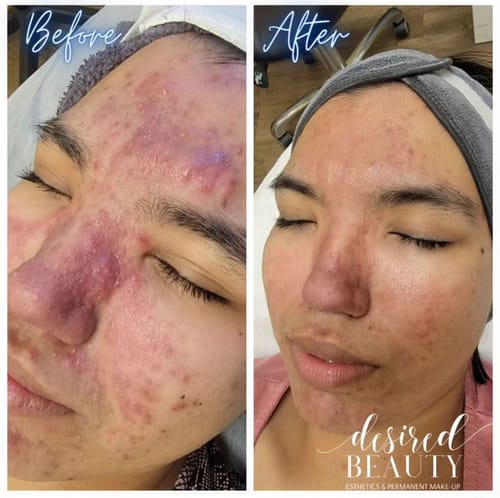 Customer photo review of KrX PD-13 Therapy Kit