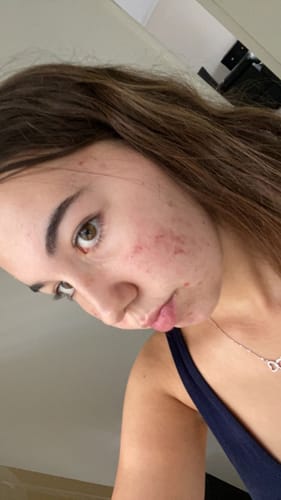 Customer photo review of Advanced Acne Program™