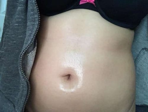 Customer photo review of Lymphatic Drainage Ginger Oil - Last Day Promotion