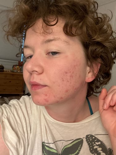 Customer photo review of The Complete Acne System for Women