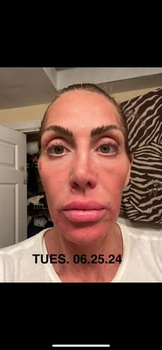 Customer photo review of JOVS 4D Laser Light Therapy Mask