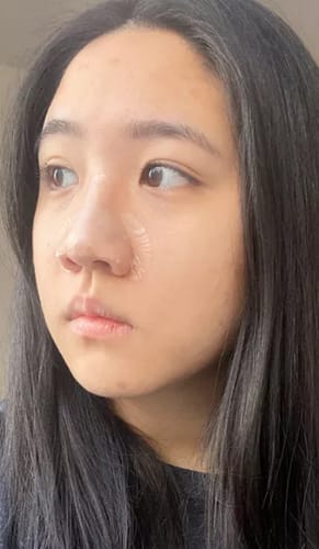 Customer photo review of Luelle Pimple Patches