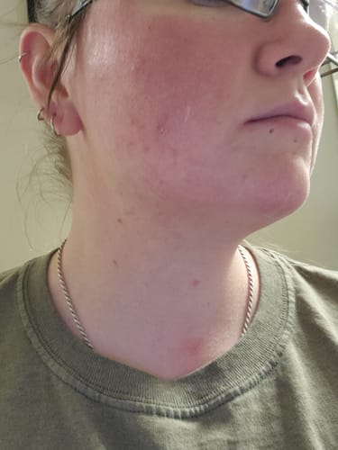 Customer photo review of The Complete Acne System for Women