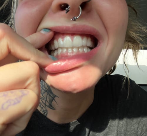 Customer photo review of Upper and Lower Retainers Set