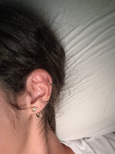 Customer photo review of Piercing Bump Treatment - Bump, Keloid & Scar Relief Oil