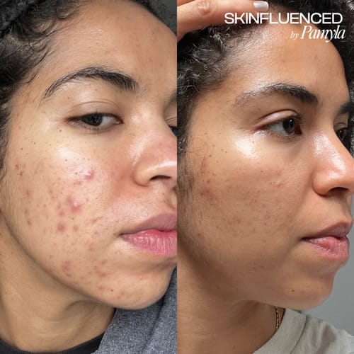 Customer photo review of KrX PD-13 Therapy Kit