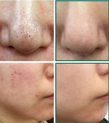 Customer photo review of Diystar™ Deep Cleanse & Bacteria-Fighting Green Tea Mask