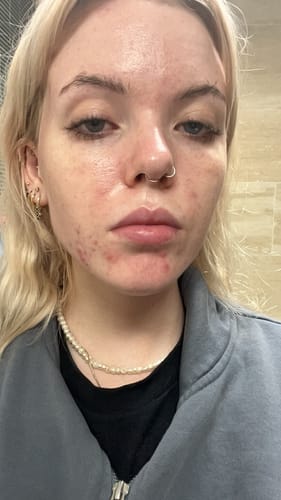 Customer photo review of Advanced Acne Program™