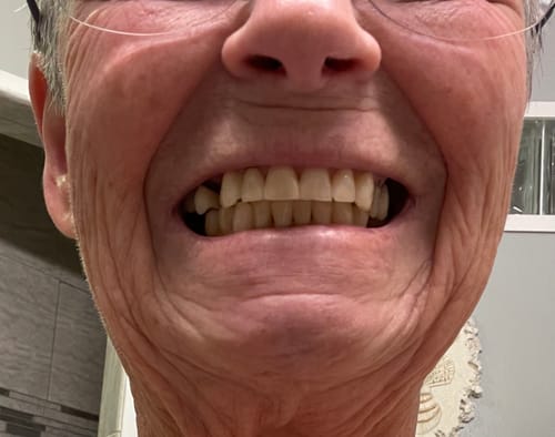 Customer photo review of Flexible Partial Denture, Includes 1 tooth, Save $56 with promotional code:TCG15