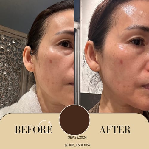 Customer photo review of KrX Lazer Peel