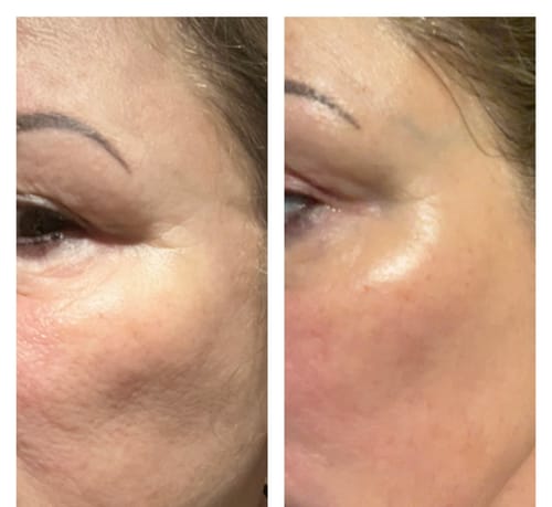 Customer photo review of Glov Micro Infusion System