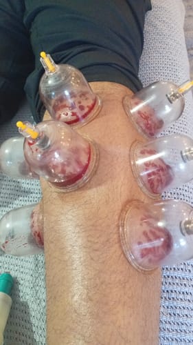 Customer photo review of Standard Cupping Cups - Mixed Sizes from B1 to B6