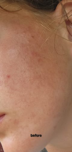 Customer photo review of Starter Acne Program™