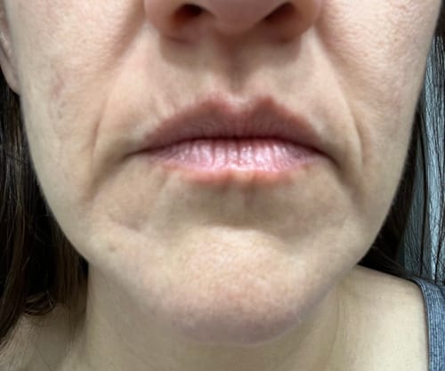 Customer photo review of Glov Micro Infusion System