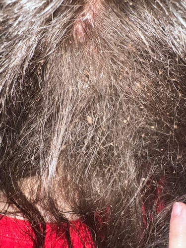 Customer photo review of Heal Your Scalp: Sores, Scabs, Dandruff, Itching, Eczema and Psoriasis Shampoo Bundle