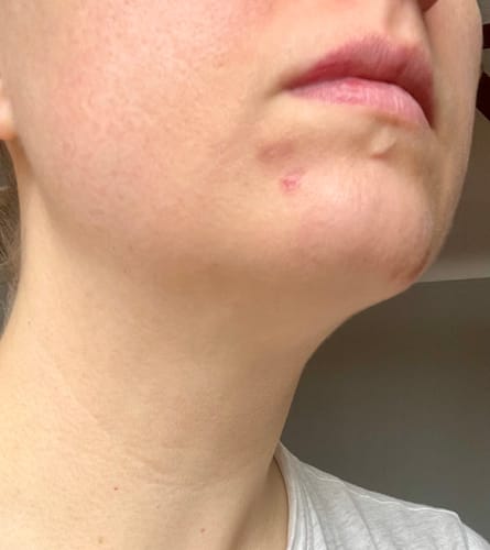Customer photo review of Instant Rosacea, Acne & Redness Stopper