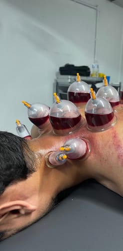Customer photo review of Premium Cupping Cups - Mixed Sizes from B1 to B6