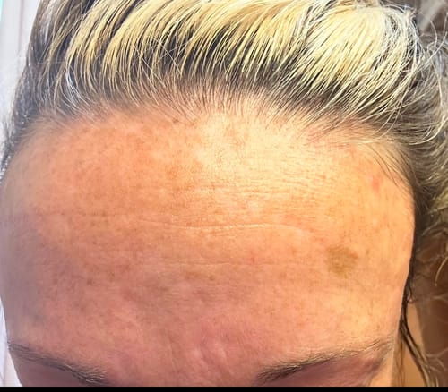 Customer photo review of Glov Micro Infusion System