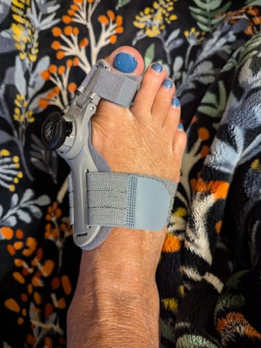 Customer photo review of Treatmedy™ Bunion Fix - Natural At-Home Bunion Relief