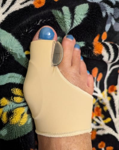 Customer photo review of Treatmedy™ Orthopedic Daytime Bunion Sleeve