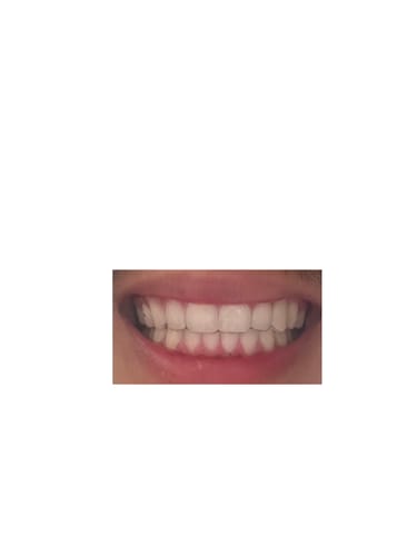 Customer photo review of Upper Partial Denture Retainer (1 Tooth Only)