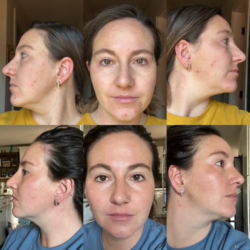 Customer photo review of The Complete Acne Killer System 2.0