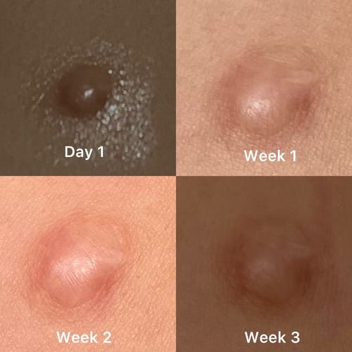 Customer photo review of Keloid Bump Shrinking Duo