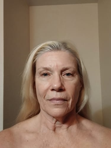 Customer photo review of The Micro Infusion System™