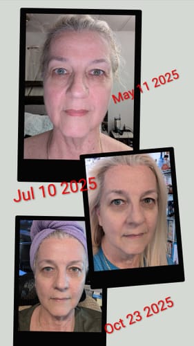 Customer photo review of The Micro Infusion System™