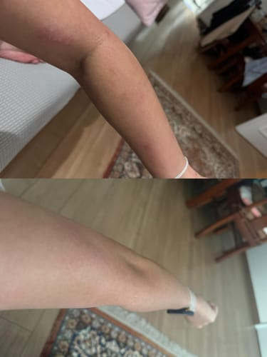 Customer photo review of Eczema Scratch Mitten