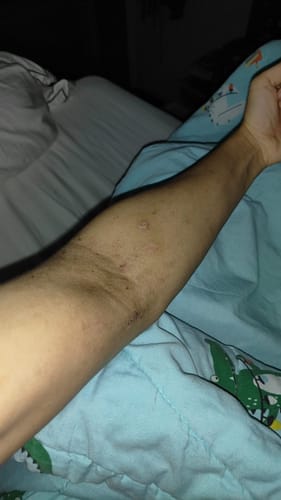 Customer photo review of Eczema Scratch Mitten