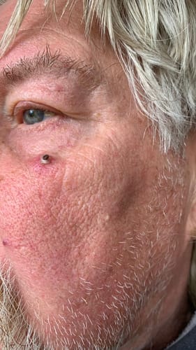 Customer photo review of LumiClear™ – Removedor de Verrugas Avanzado