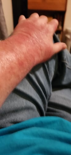 Customer photo review of EczPro - Probiotics for Eczema, Natural Remedy, 13 Histamine-Safe Strains, Allergen-Free Formula