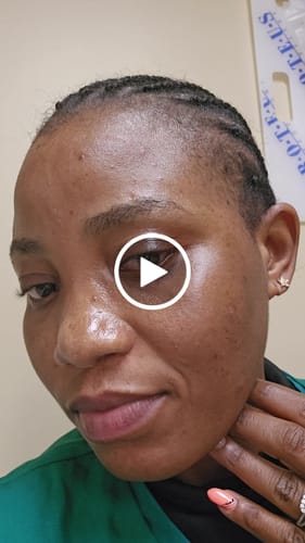 Customer video review of Intense Discoloration Treatment (Rapid Action)