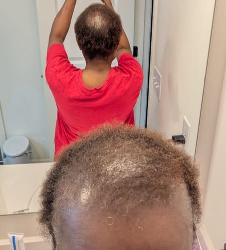 Customer photo review of Rennora Hair Growth Serum