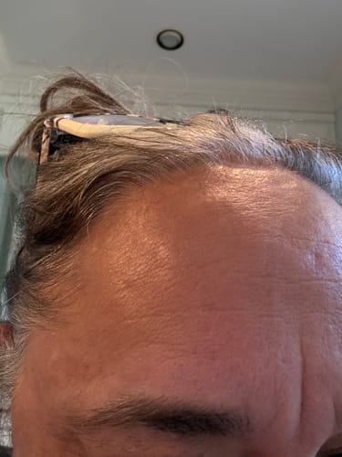 Customer photo review of 3 Month Supply - Seranova Micro Infusion System