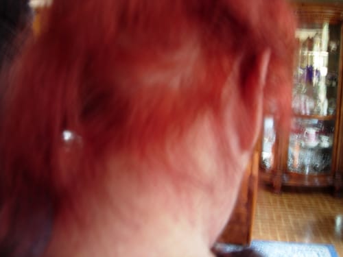 Customer photo review of 10% Minoxytop Minoxidil Extra Strength Topical Solution for Men.