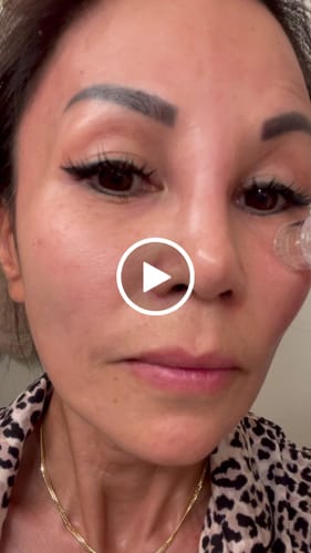 Customer video review of 2 Month Supply of Seranova Microneedling Infusion System™