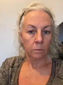 Customer photo review of Sistema de Microinfusão™ + Soro Bónus